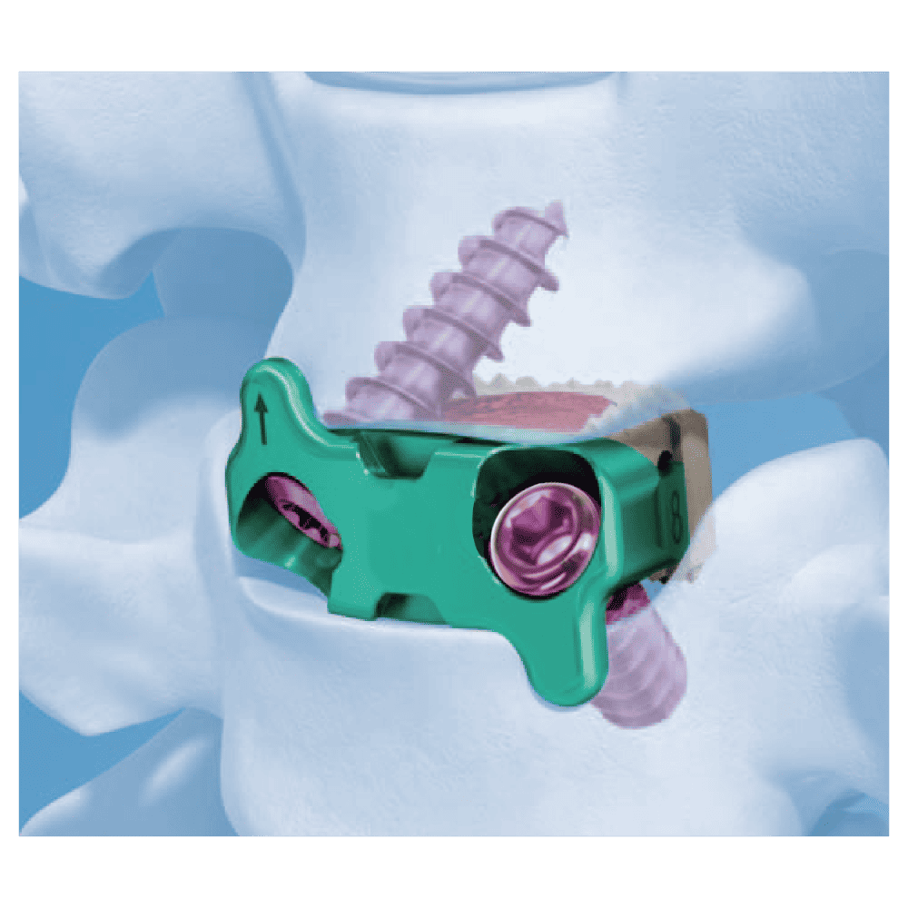 Cervical Zero Notch Interbody Fusion Cage System